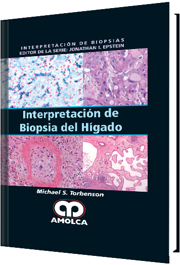 Interpretación de Biopsia del Hígado