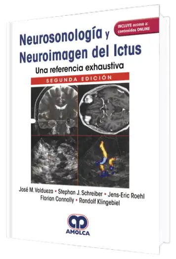 Neurosonología y Neuroimagen del Ictus una Referencia Exhaustiva.  2 Edición