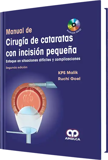 Manual de Cirugía de Cataratas con Incisión Pequeña. 2 Edición