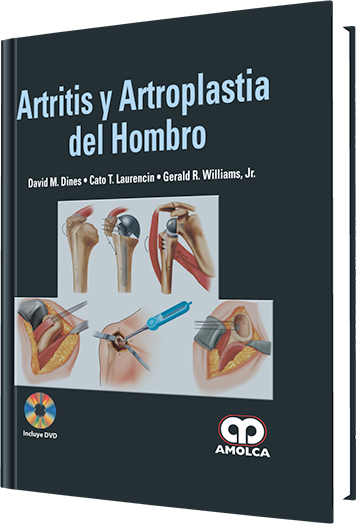 Artritis y Artroplastia del Hombro