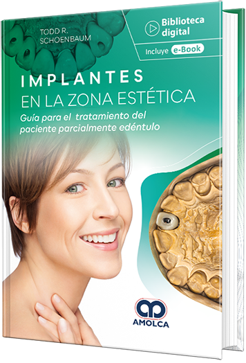 Implantes en la zona estética